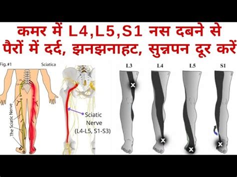 l5 nerve root compression test|l5 nerve root irritation.